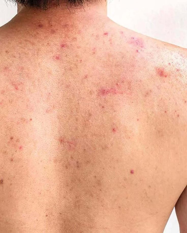 تمرکز روی مراقبت‌های پوستی بعد از فصد خون برای کاهش جوش و التهابات پوست صورت و بدن